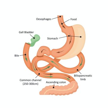 SADI-S surgery